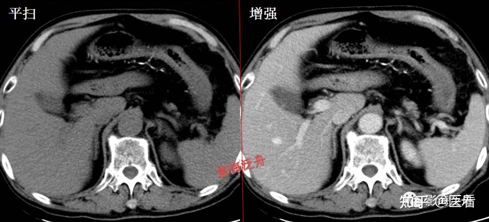 幽门梗阻ct图片