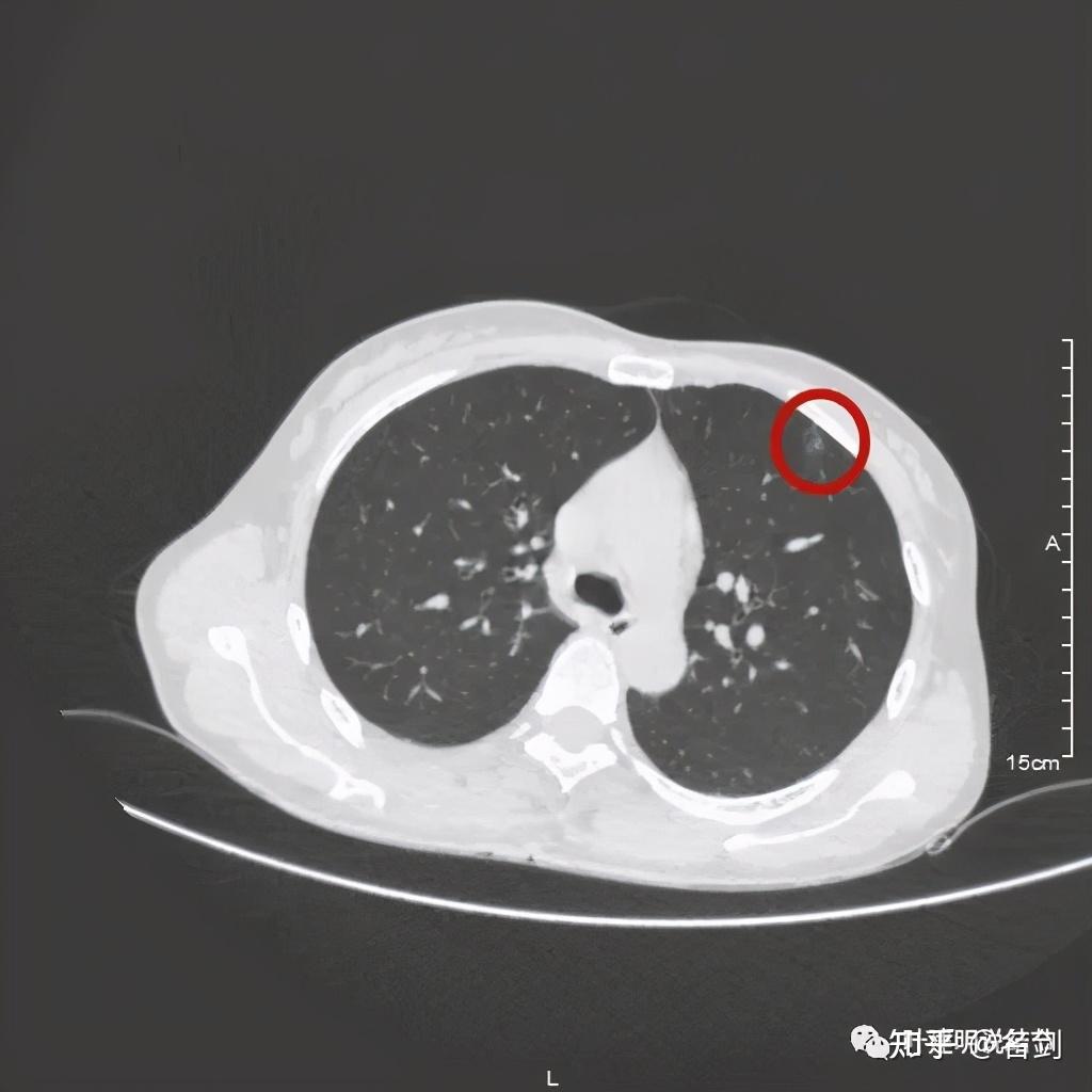 两肺多达9处结节,是否要手术?临床如何决策? 