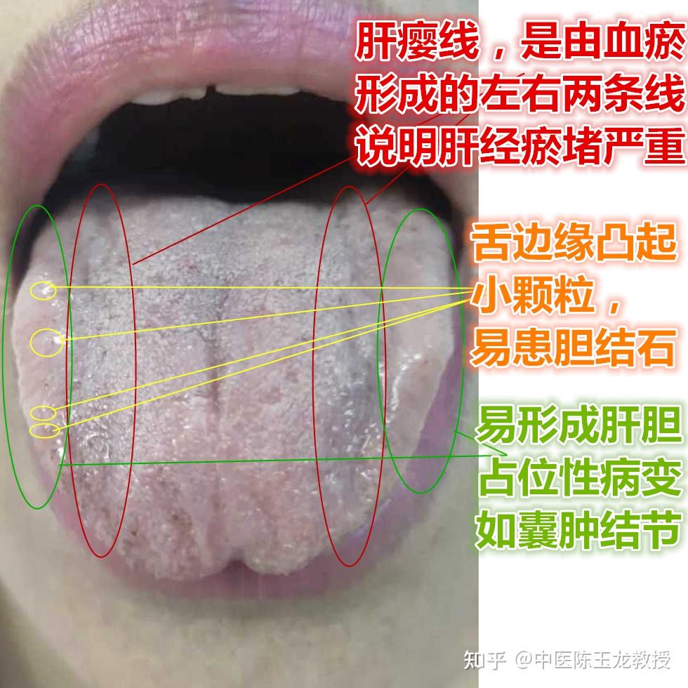 神奇话中医!舌诊堪比彩超、CT,一望就知你体内是否有肿瘤、结石 - 知乎