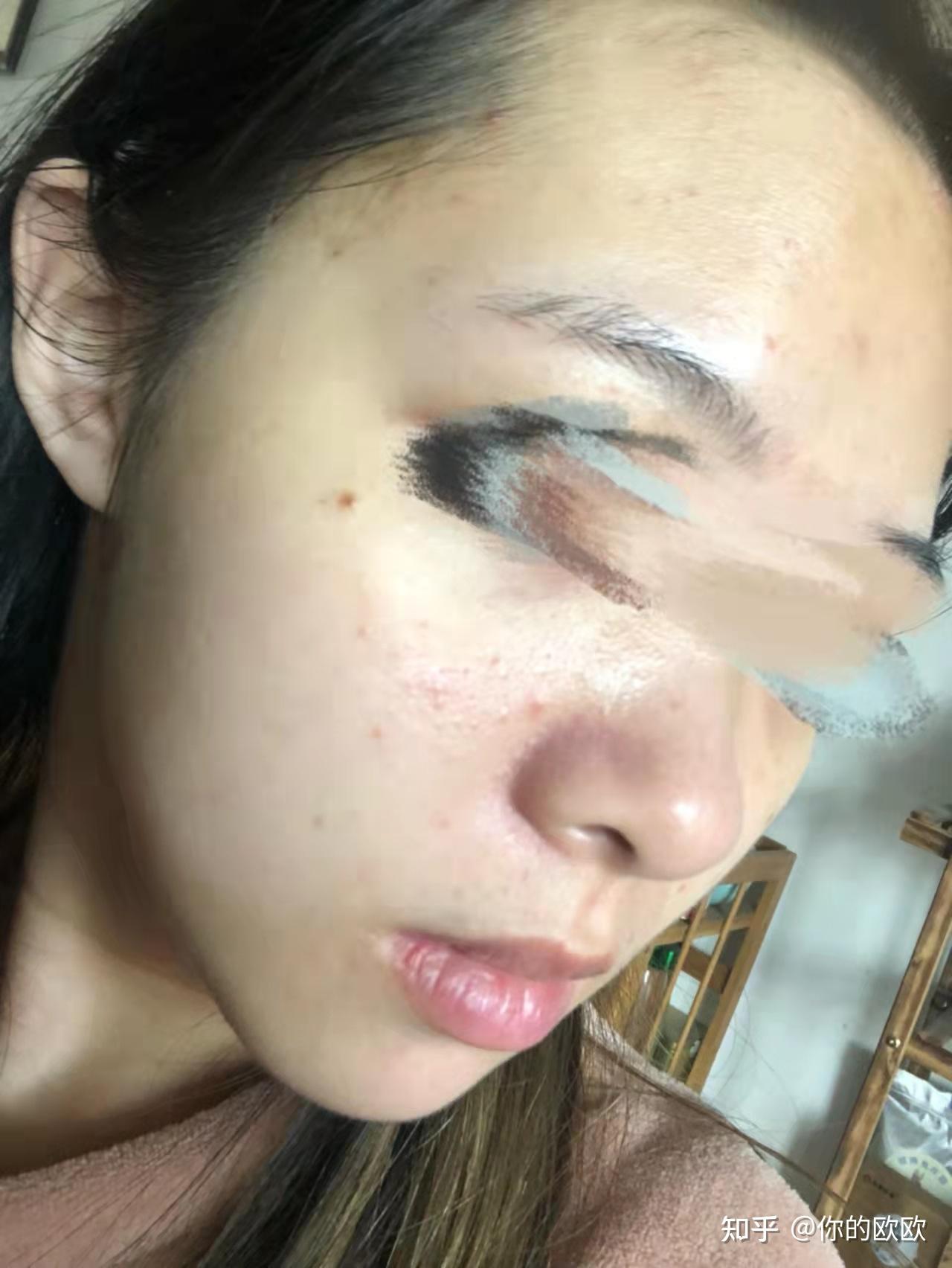 这是我皮肤最差的时候