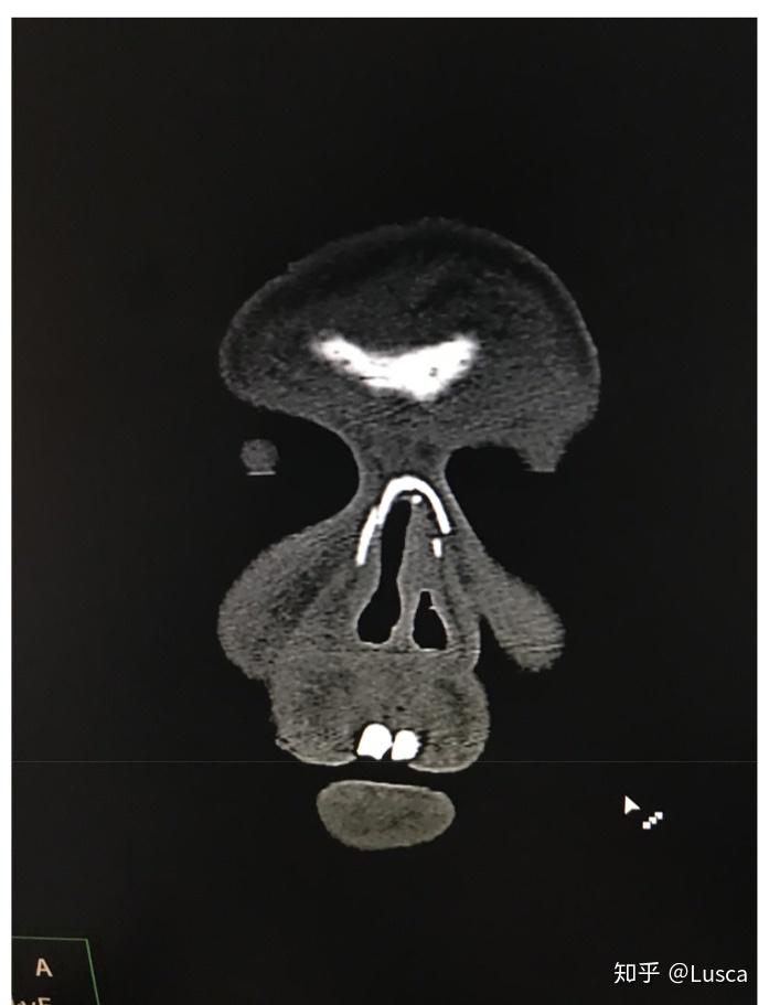 严重的颅面部骨折lefort骨折