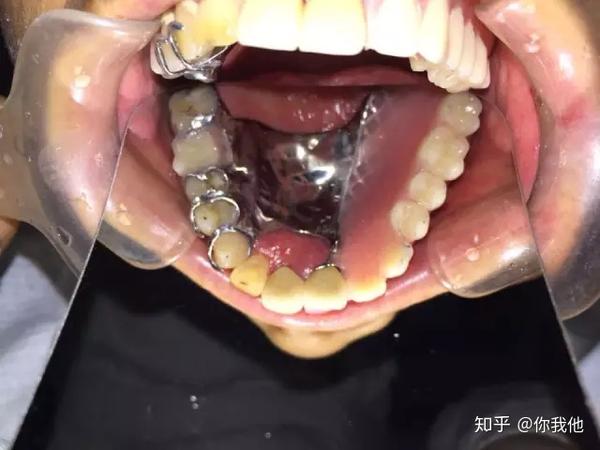 金属3d打印应用于牙科领域实例