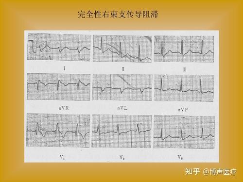 博声医疗 完全性右束支传导阻滞 知乎