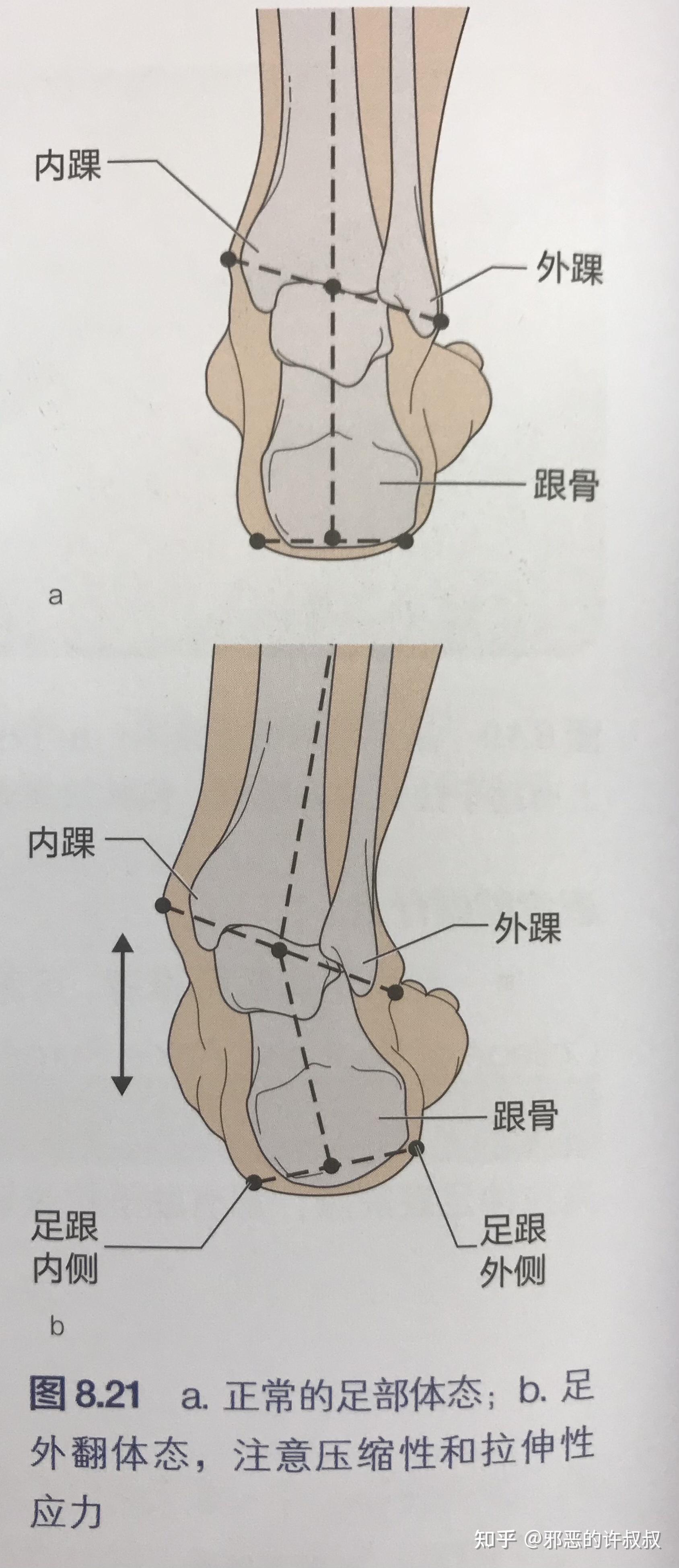 系列解决膝关节疼痛小腿外翻胫骨外旋和功能扁平足的关键点之胫骨后肌