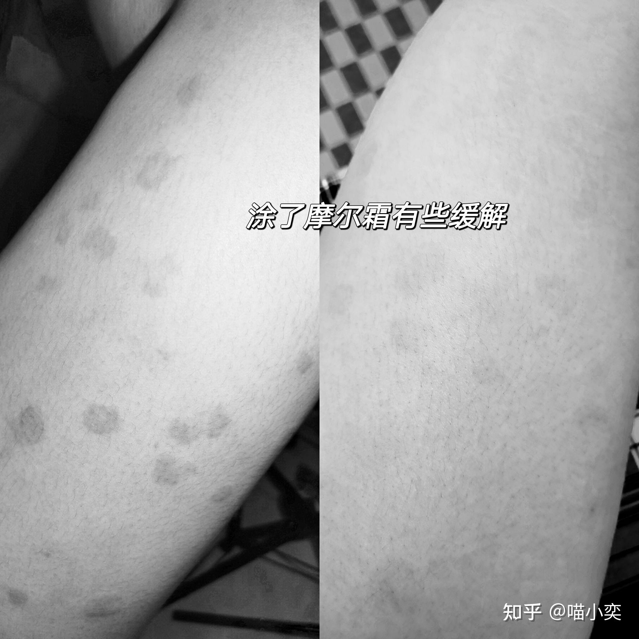 胆碱能性荨麻疹-京东健康