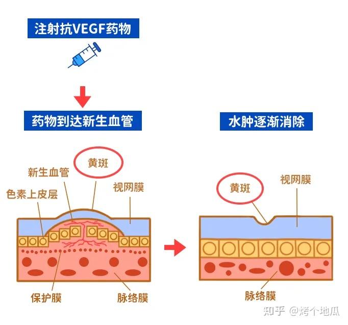 糖尿病性黃斑水腫出現病情反覆可能是這3點原因