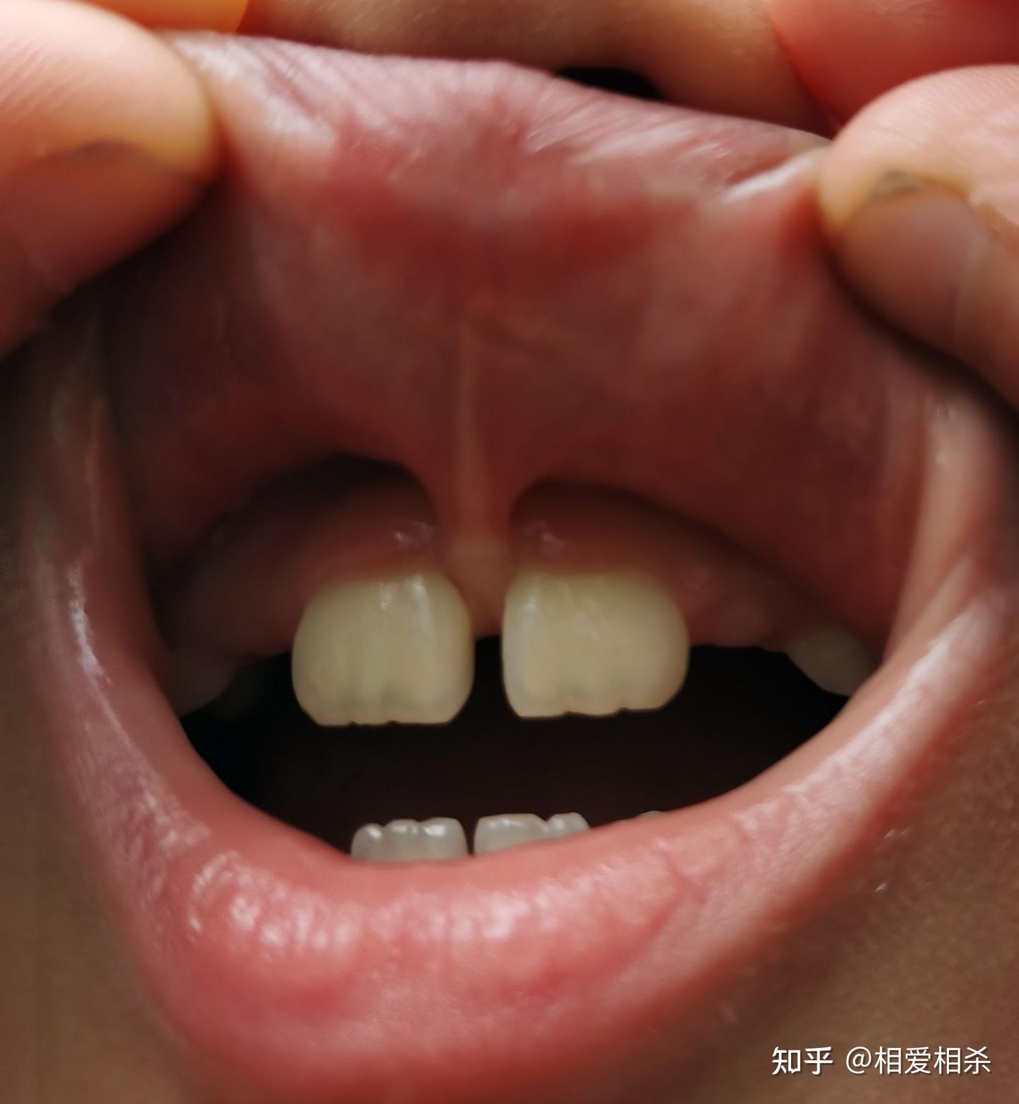 上唇系带短需要手术吗? - 知乎