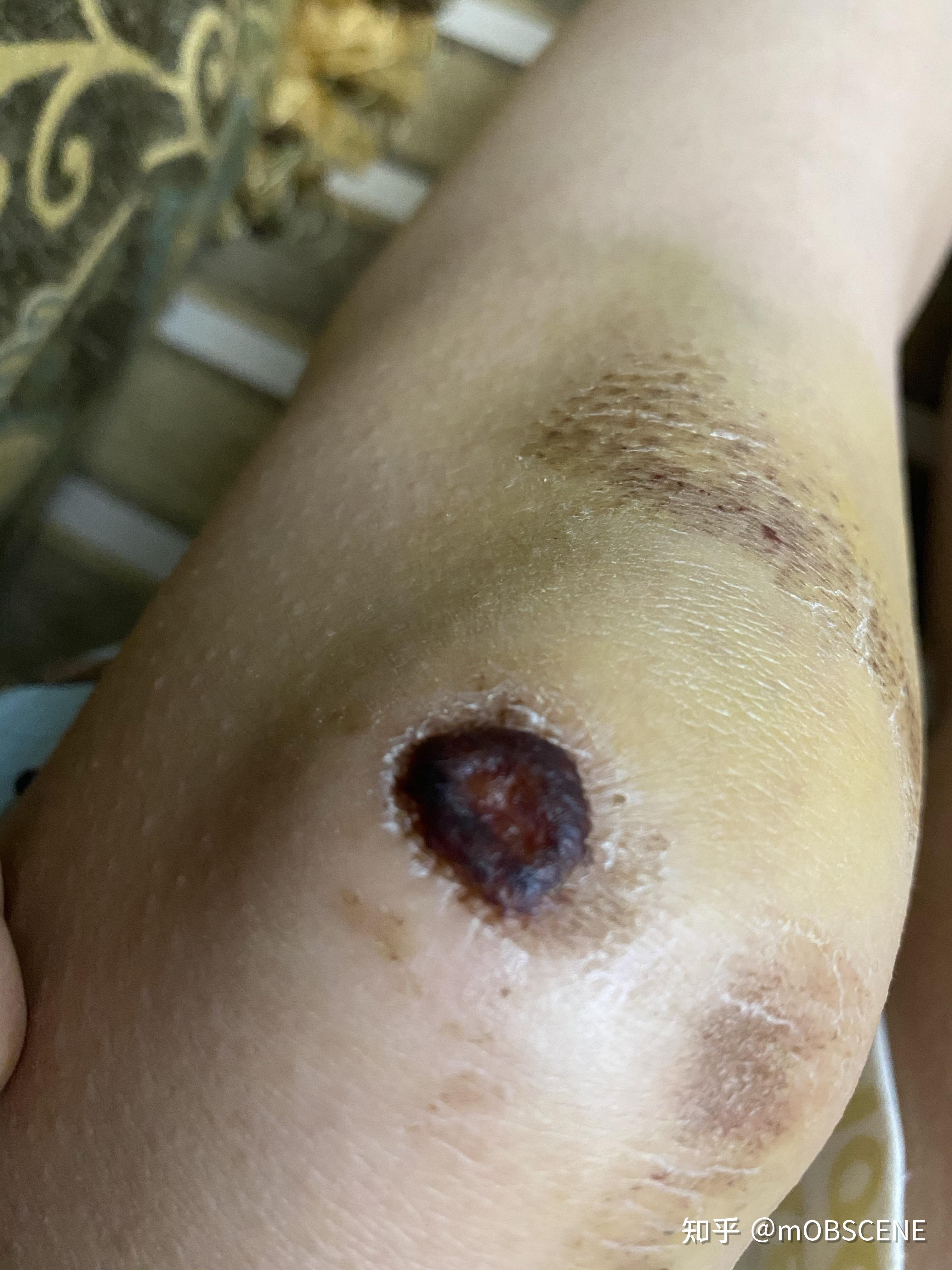 记录膝盖擦伤 - 知乎