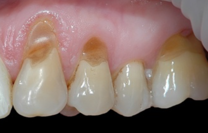 牙釉质,釉本身就是光滑细腻的代名词,所以牙釉质保护的越好,牙齿就会