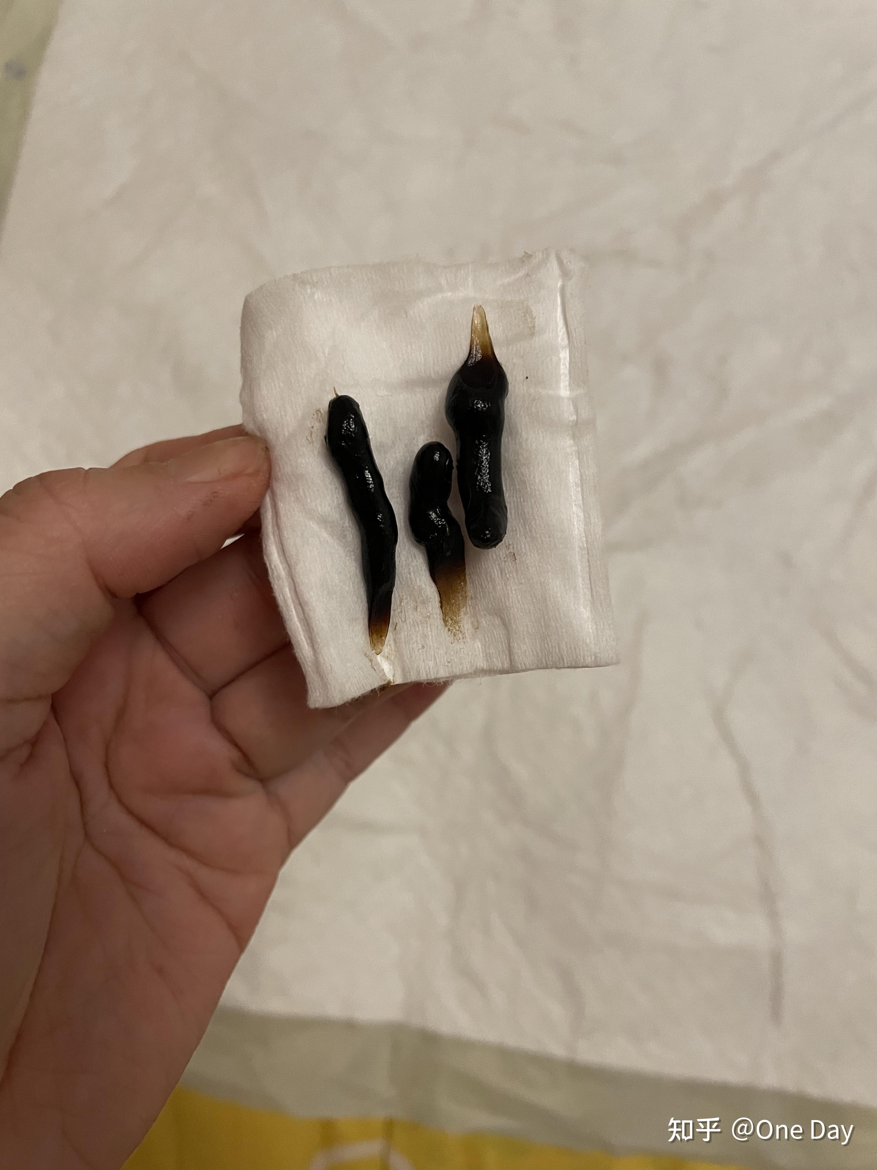 前庭大腺囊肿第三次复发