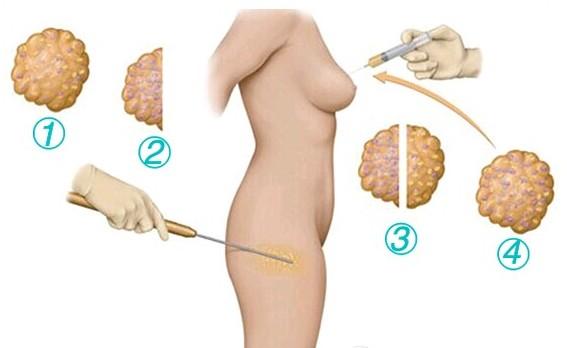 自体脂肪填充是永久的吗?