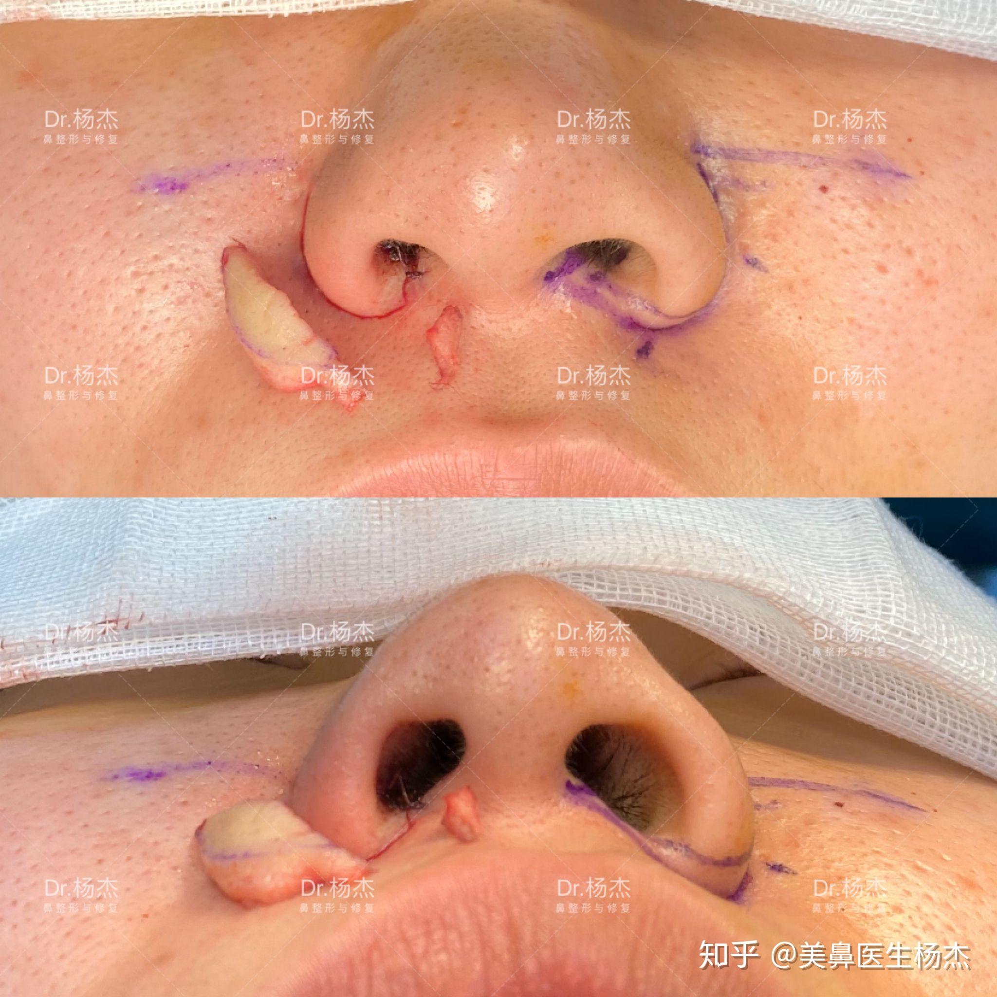 手术采取鼻翼内外联合切除:1.双侧鼻翼外切(a段  约4mm)2.