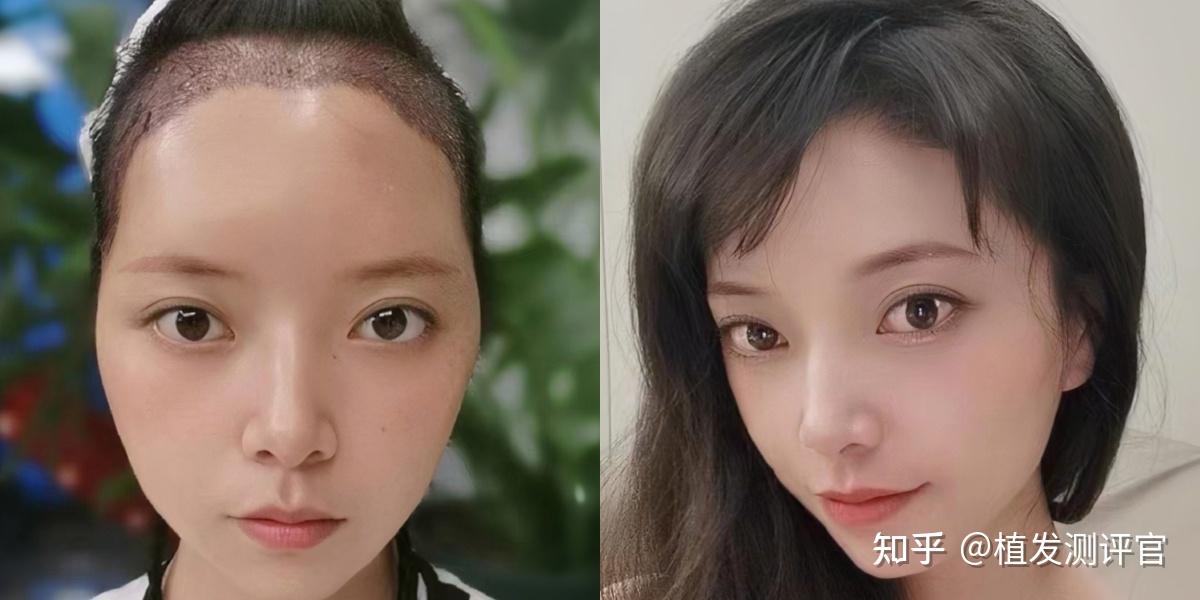 南京有做植发的吗(南京有植发好的医院吗)