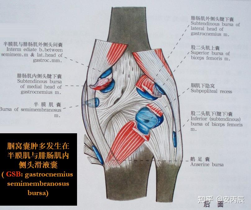 腘窝囊肿的诊治要点