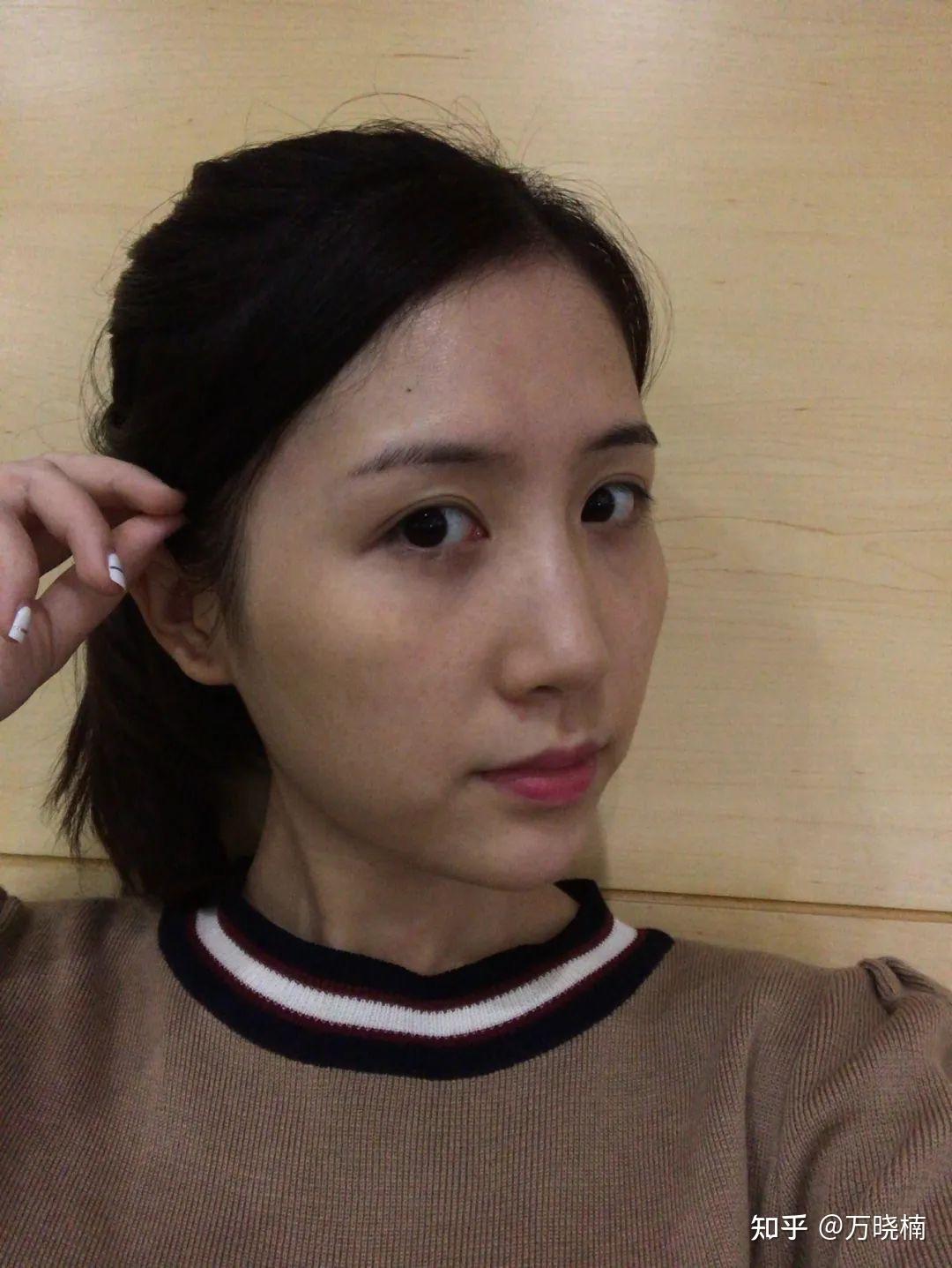 面部松弛凹陷,不知先做提升还是填充? - 知乎