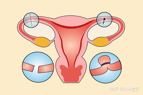 输卵管堵了怎么做试管(输卵管堵试管成功率高吗)-第2张图片-鲸幼网