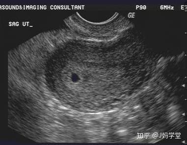 受孕多久后能看到孕囊 孕检b超发现空胎囊要怎么办 先弄清原因 知乎