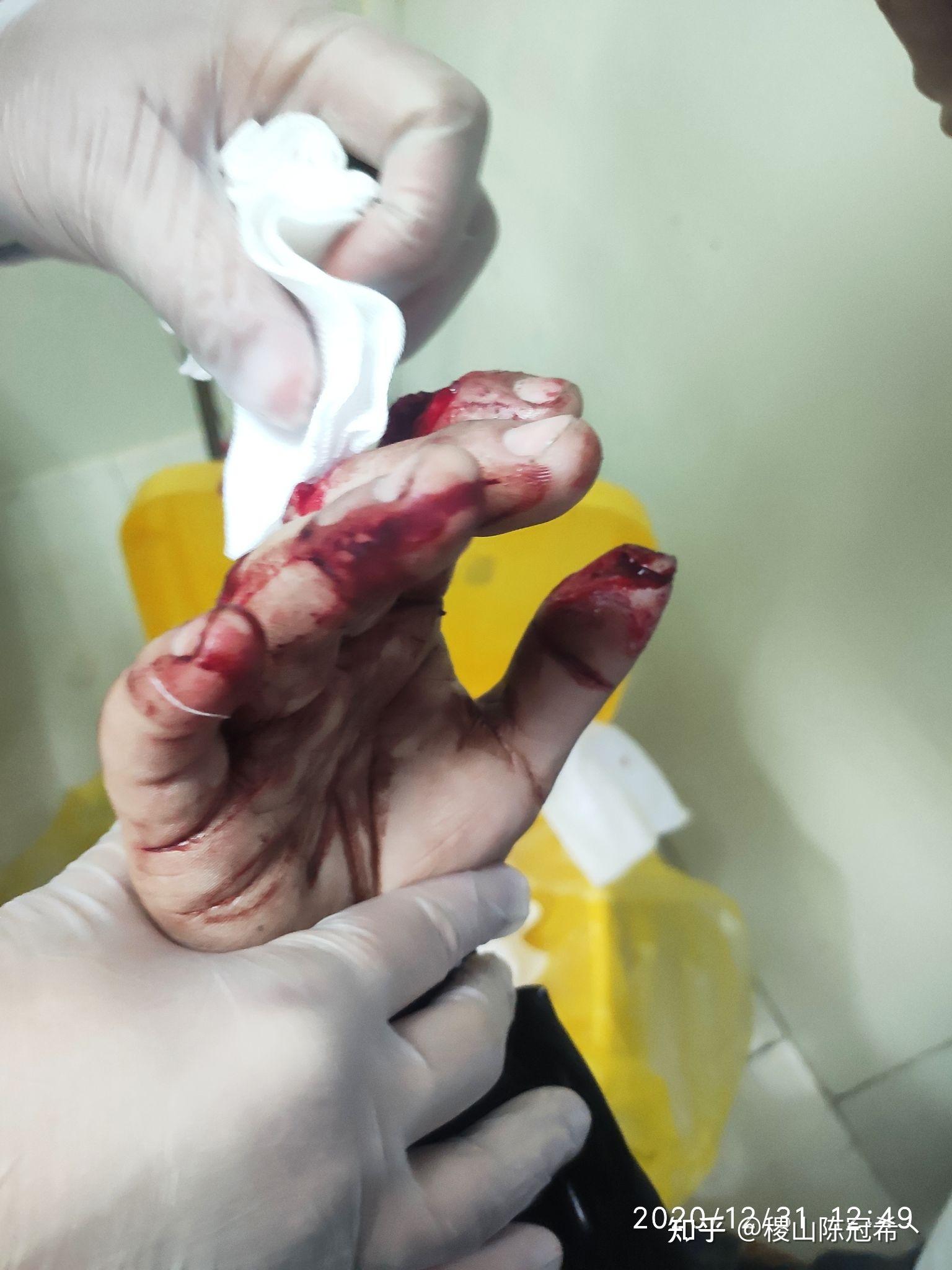 手指被割掉一块肉是什么体验? - 知乎