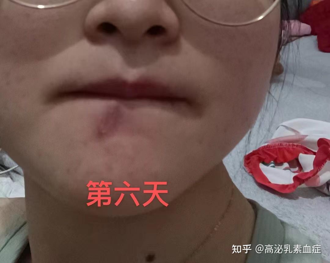 手术切痣嘴角下方痣(好吃痣) 坐标:厦门