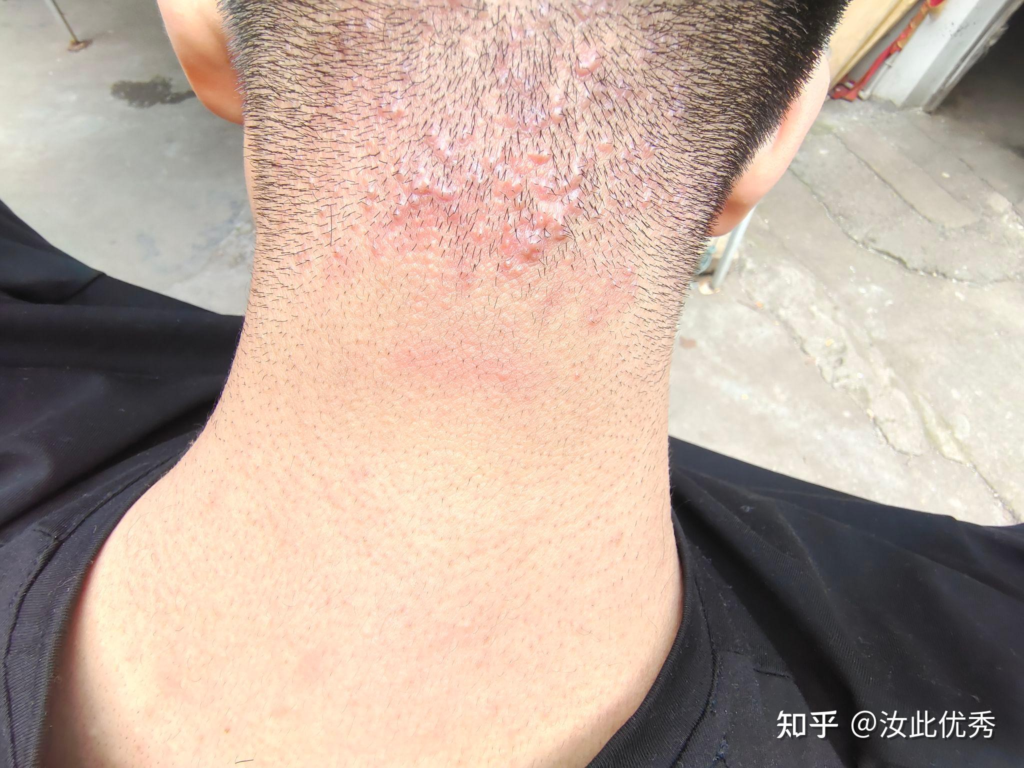 脖子后面毛囊炎? - 知乎