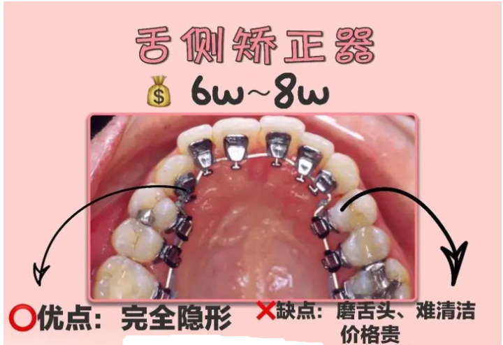 重庆正畸医院医生那个好?重庆舌侧矫正价格?重庆不拔牙正畸好处和坏处? - 知乎