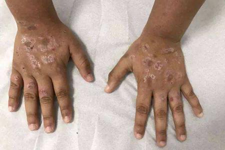 儿童也会得风湿有这几个症状家长可得留意了