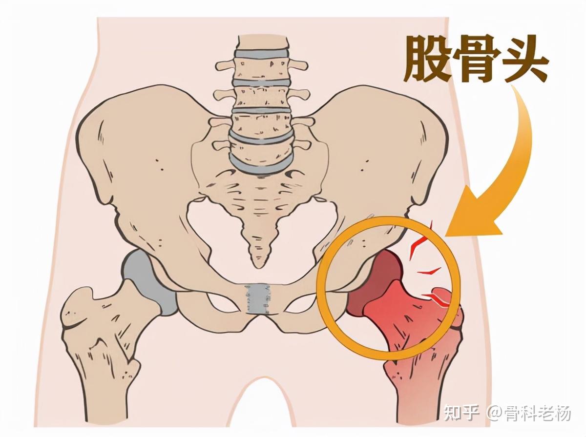 患者一定要早點進行股骨頭壞死的檢查