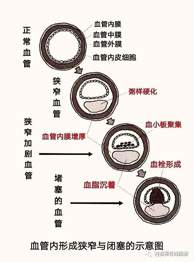 如何简单自测与判断动脉是否硬化 - 知乎
