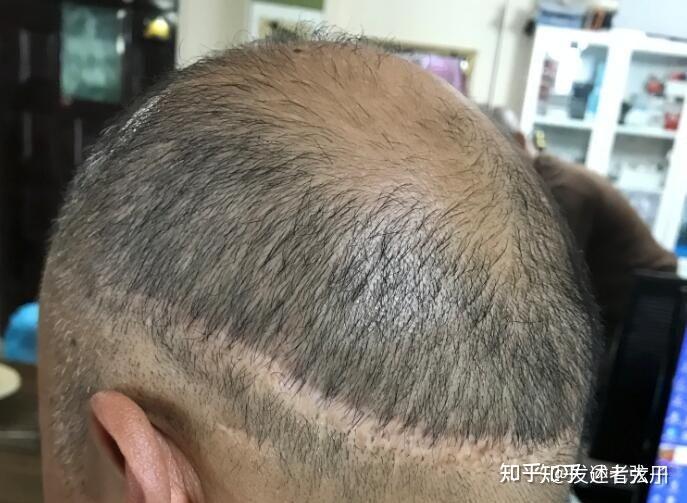 植发避雷合集(帮女生植发攻略)