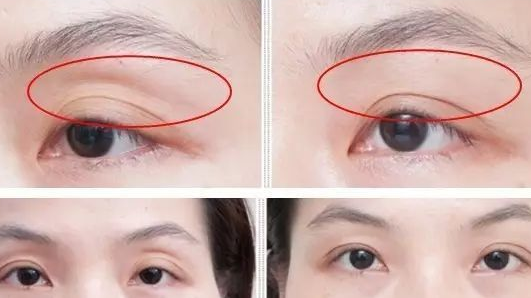 脂肪填充眼窝风险大不大?杭州填充眼窝好的医生有哪些?