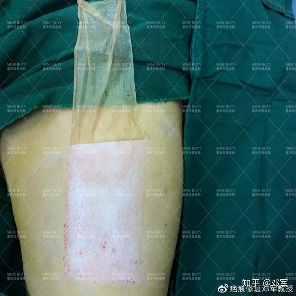 健康科普丨关于游离植皮术,这几点你必须知道 - 知乎