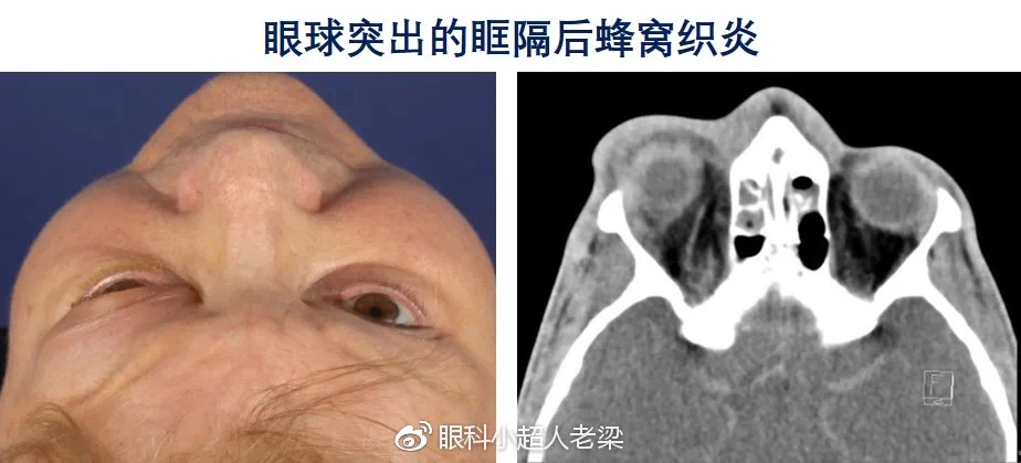 眶隔后蜂窝织炎