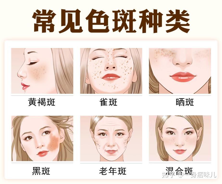 上各种深色斑点的统称,包括雀斑,晒斑,黄褐斑,老年斑,妊娠斑,混合斑