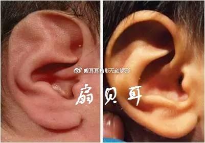 先天性耳廓形态畸形之三:扇贝耳