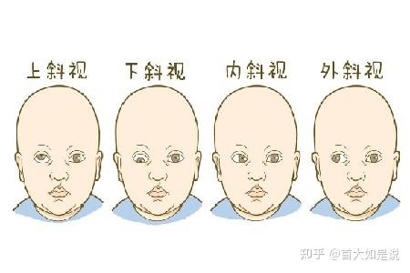 首大熊瑛兒童斜視常見的表現有哪些