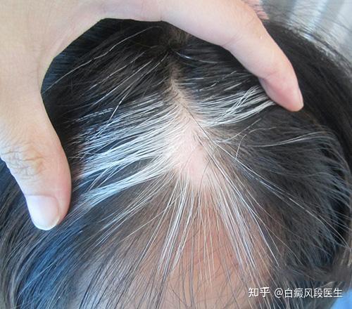 发根变白要当心！可能是毛囊型白癜风出现的信号 - 知乎