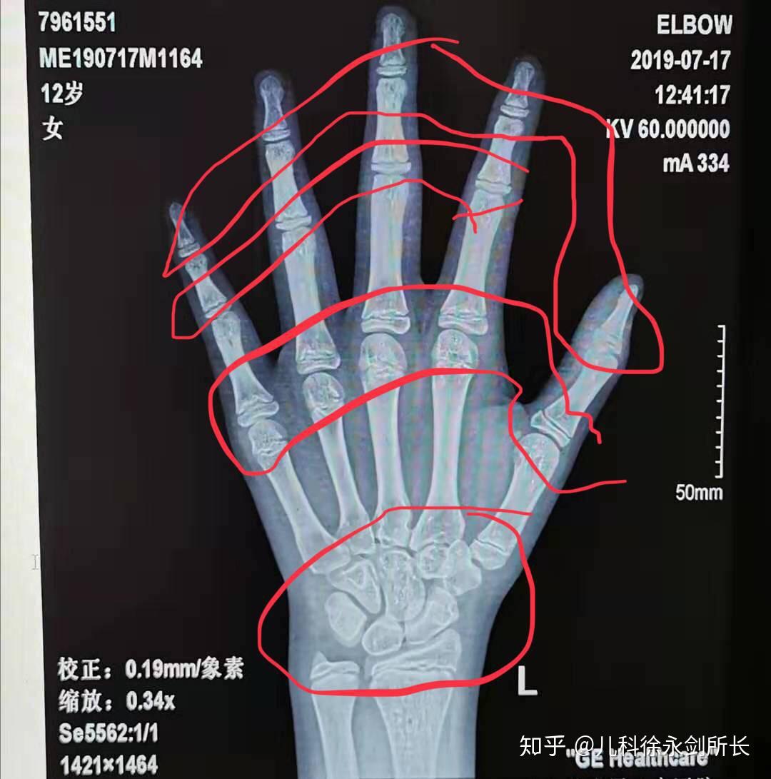 骨龄检测的标准不一样结果差异较大
