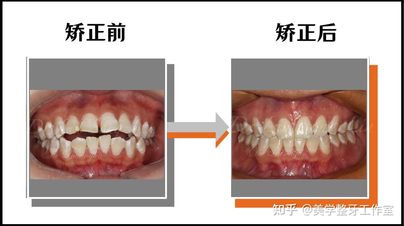牙齿开合，嘴唇闭不上，戴牙套能矫正吗？ - 知乎