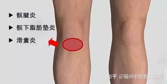 健康科普丨不同位置膝盖痛都是什么原因造成的 知乎