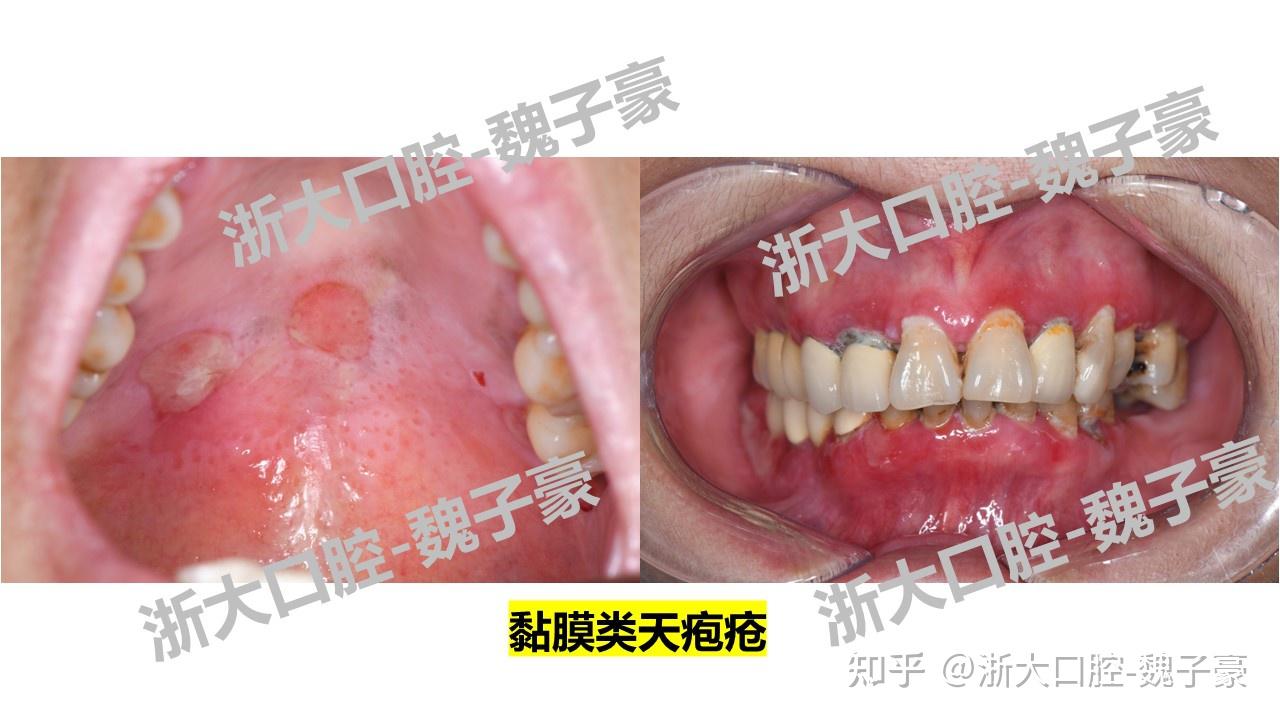 口腔黏膜大疱类疾病 简介 - 知乎
