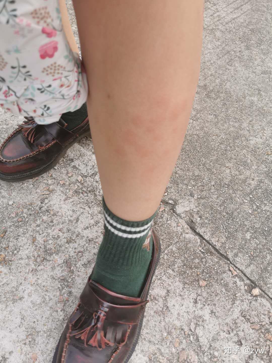 记录我的丘疹性荨麻疹治疗过程 - 知乎