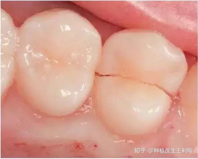 1,容易发生牙齿折裂首先,牙齿的发育是各不相同的,有些人的牙面发育沟