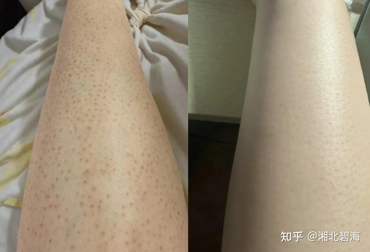 为什么鸡皮总是反反复复的好不了?? - 知乎