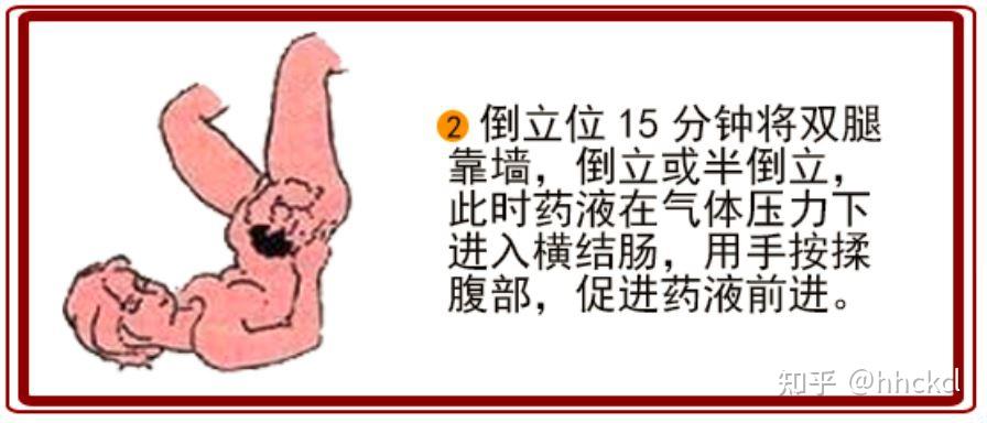 溃疡性结肠炎的灌肠方法