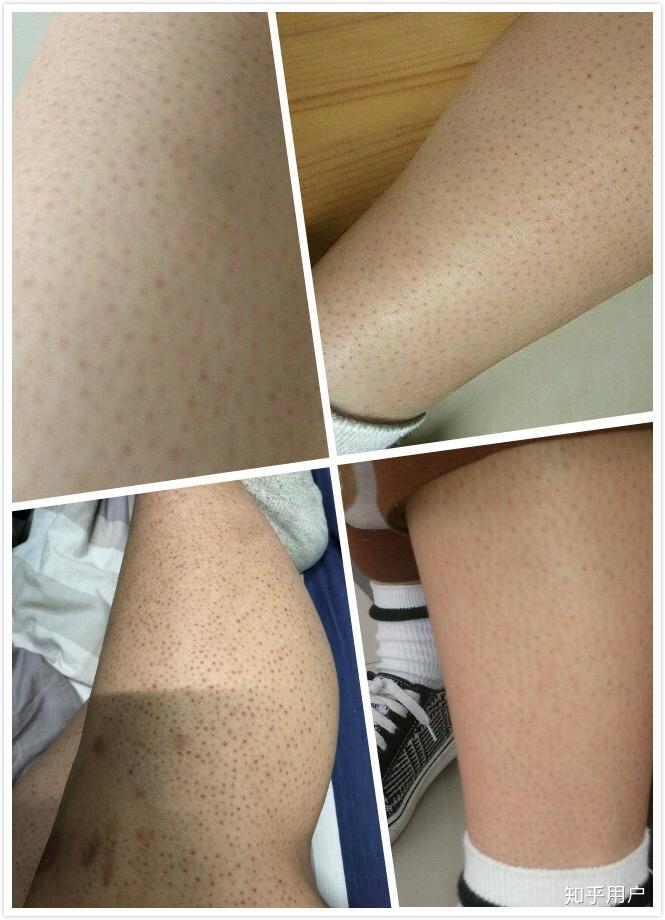 包含鸡皮肤是什么手机壁纸高级的词条