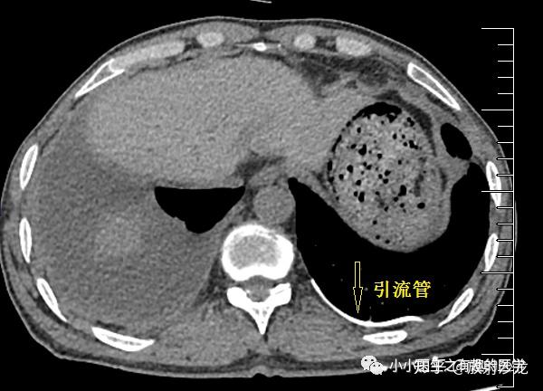 有趣病例游走的胸腔积液