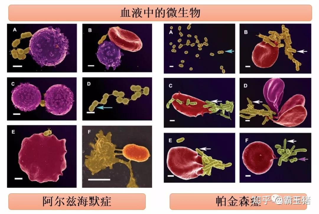 微生物(并非菌血症),血液中细菌有毒代谢物增加(如细菌内毒素脂多糖)