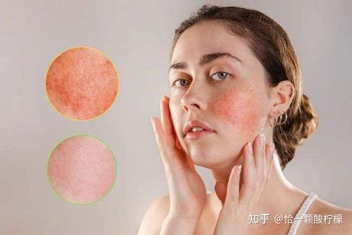 面部皮肤过敏红痒怎么办?敏感肌肤实用护肤技巧 - 知乎