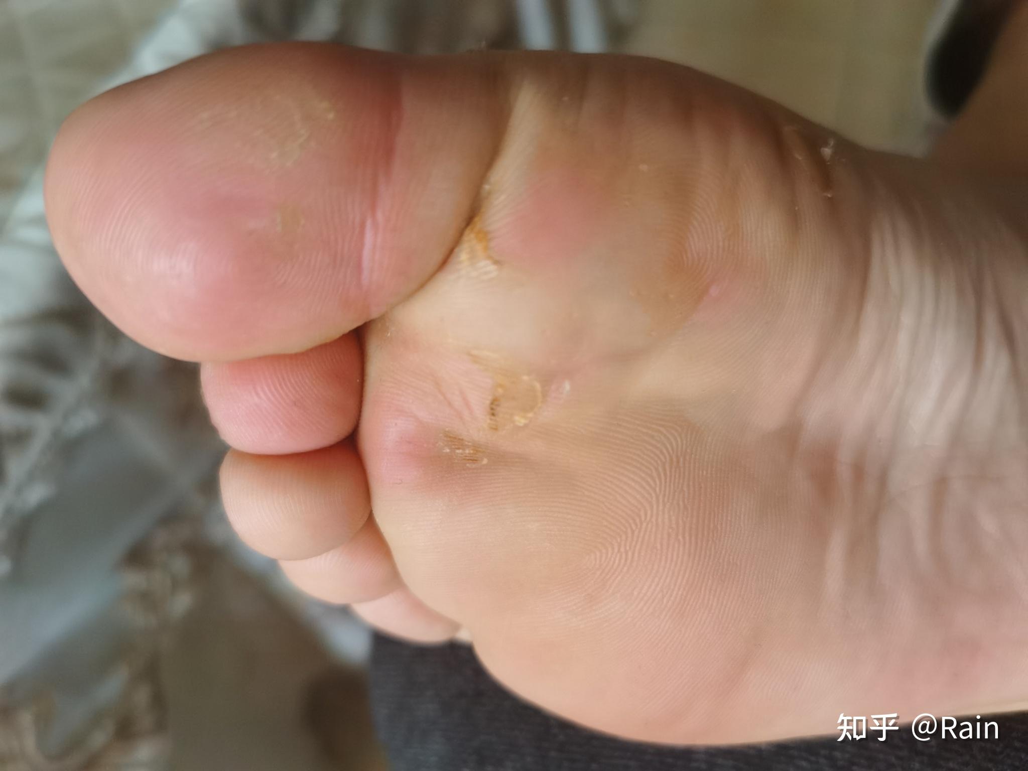 得脚趾疣千万不要去路边修脚店亲身经历