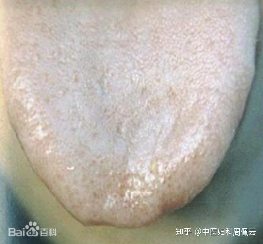 舌诊 | 从舌苔看健康,舌头这4种颜色需要注意! - 知乎